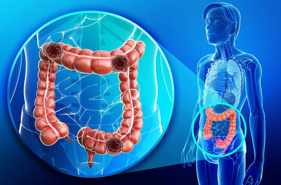 Bağırsak Hastalıkları: Belirtiler, Nedenler, Tanı ve Tedavi