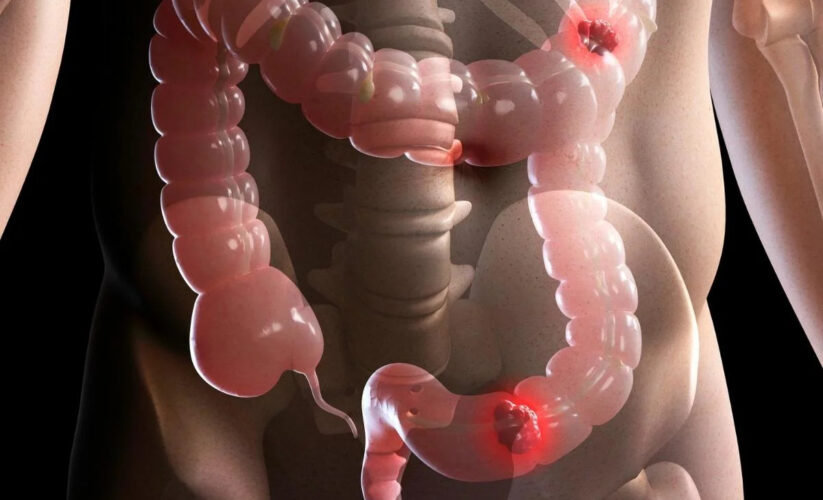 Bağırsak Hastalıkları Hakkında Bilmeniz Gereken Her Şey: Gizli Belirtilerden Etkili Tedavilere