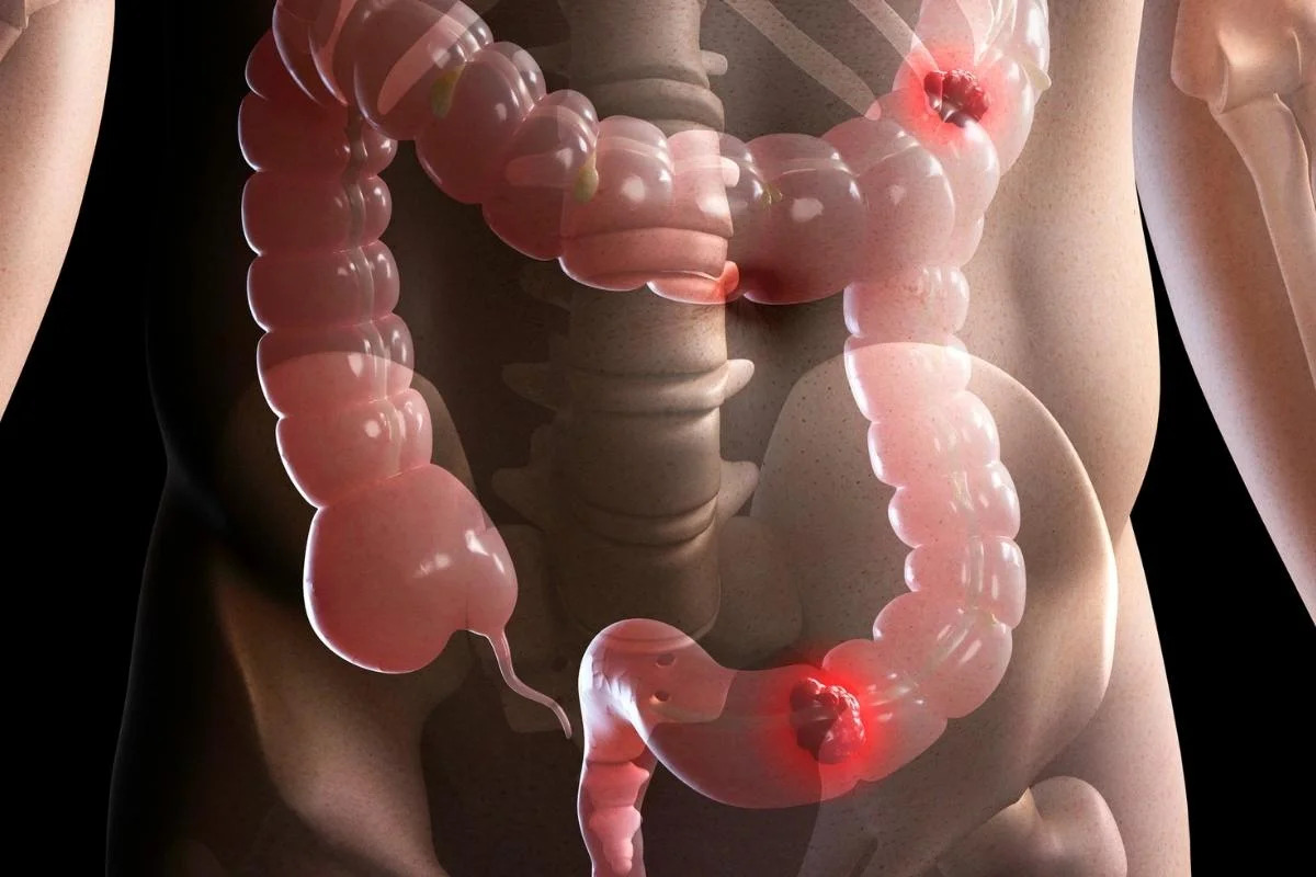 Bağırsak Hastalıkları Hakkında Bilmeniz Gereken Her Şey: Gizli Belirtilerden Etkili Tedavilere