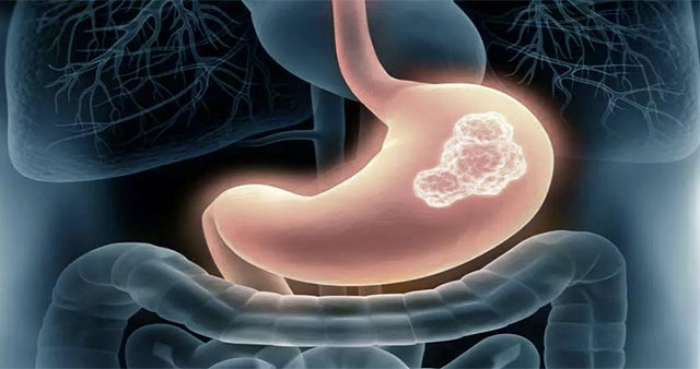 Polip Nedir, Nasıl Alınır?