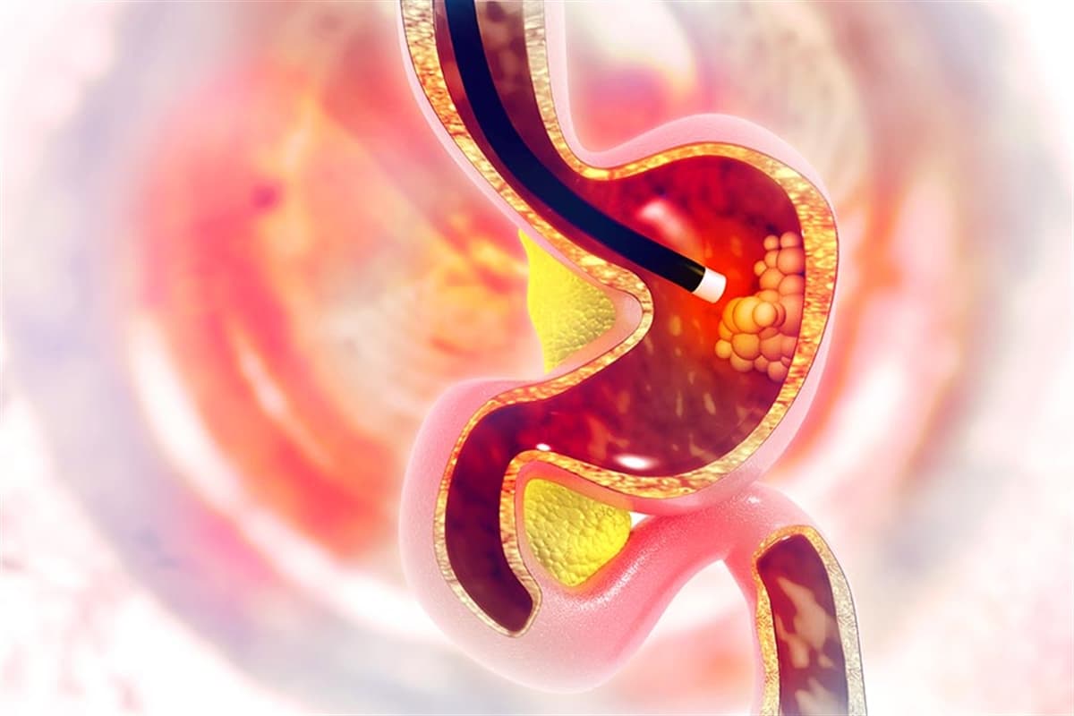 Endoskopi Nasıl Yapılır