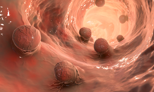 Polip Nedir? Nasıl Alınır?